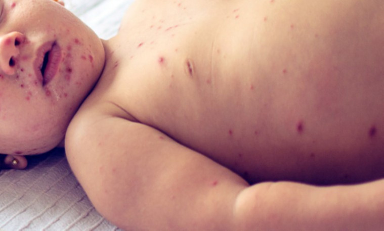 Улаанбурхан өвчнөөр ХӨСҮТ-д 4, орон нутагт 7 хүн хэвтэн эмчлүүлж байна